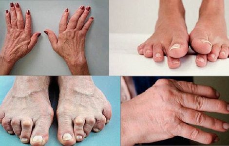 Симптомы и лечение псориатического артрита