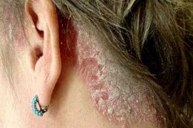 Правила питания при псориазе – подробное меню и таблица продуктов