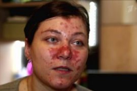 Чем лечить псориаз на теле