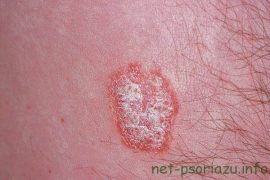 Фото псориаза по стадиям