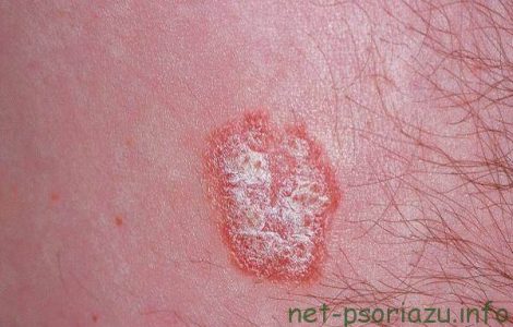 Psorix от псориаза: отзывы, цена, где купить, развод или правда