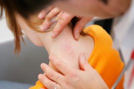 Первые признаки псориаза у детей