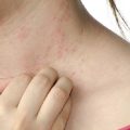 Зуд при псориазе: основные причины появления и способы борьбы