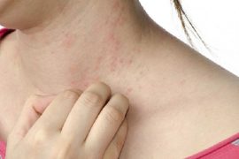 Зуд при псориазе: основные причины появления и способы борьбы
