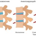 Псориатический артрит что это такое