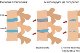 Псориатический артрит что это такое