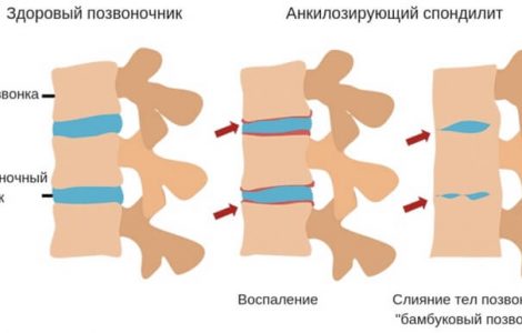 Псориатический артрит что это такое