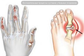 Псориатический артрит – загадочное и непредсказуемое заболевание. Основные методы диагностики и лечения