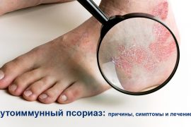 Причины возникновения, симптомы и особенности лечения аутоиммунного псориаза