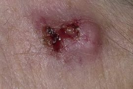 Болеют ли люди раком при псориазе