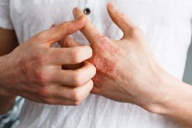Белодерм гормональная мазь или нет: рассматриваем по порядку