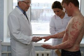 Вульгарный (бляшечный) псориаз