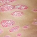 Особенности женского псориаза: первые признаки, причины, лечение