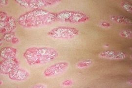 Бывает ли псориаз у детей? Как проявляется болезнь и как ее вылечить?