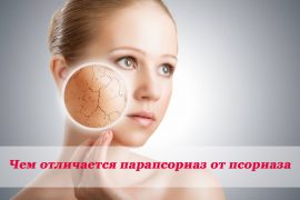 Парапсориаз