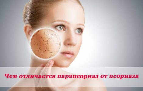 Чем парапсориаз отличается от псориаза