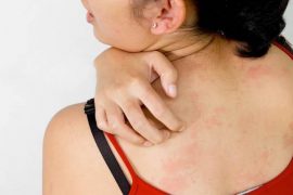 ?Может ли чесаться голова от перхоти – симптомы и способы лечения