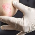 От чего может возникнуть зуд при псориазе и чем его снять?