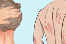Лечение псориаза в домашних условиях народными способами