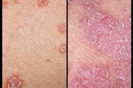 Дифференциальная диагностика псориаза и экземы