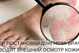Ладонно-подошвенный псориаз