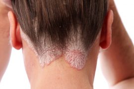 Подробные диеты при псориазе (отзывы, таблицы продуктов и меню)