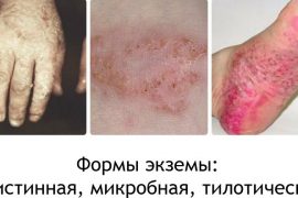 Чем отличается псориаз от экземы (фото) на руках, ногах и других частях тела