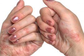 Какая самая эффективная мазь от псориаза на коже