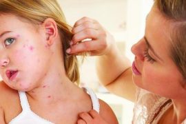 Передается ли псориаз от родителей детям и с какой вероятностью?