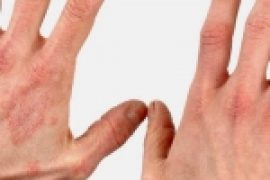Как выглядит псориаз на голове у ребенка и чем его можно вылечить?