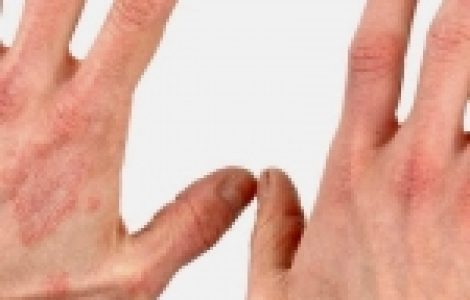 Бывает ли псориаз на лице?
