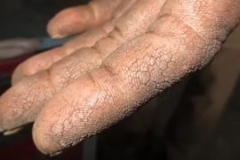 Трещины на пальцах рук при псориаз
