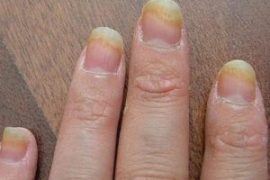 Недорогие лекарства для лечения грибка на ногах
