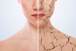 Как бороться с псориазом на локтях? Симптомы, причины появления и профилактика