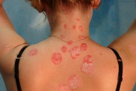 Фото начальной стадии псориаза, первые симптомы заболевания и его лечение