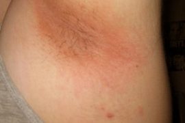 Фото начальной стадии псориаза, первые симптомы заболевания и его лечение