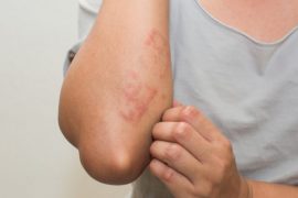 Псориаз: чем опасен, осложнения и последствия нелеченой болезни