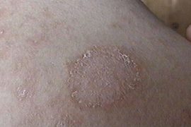 Как отличить розовый лишай и другие заболевания от псориаза