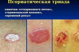 Как отличить себорею от псориаза