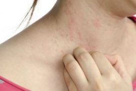 Как снять обострение псориаза на голове, руках, лице, при беремнности