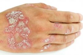 Перекись водорода при псориазе – как правильно применять?