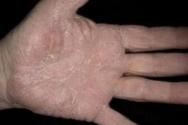 Как лечить ладонно-подошвенный псориаз?