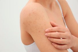 Какие бывают высыпания на коже при глистах?
