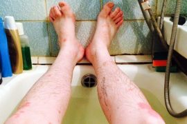 Как влияет морская вода на псориаз