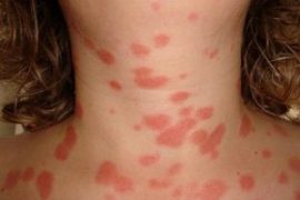 Чем лечить псориаз в домашних условиях: препараты и народные рецепты