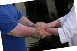 Причины и методы лечения покраснения между пальцами рук