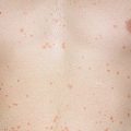 Начальные признаки псориаза – как быстро развивается болезнь