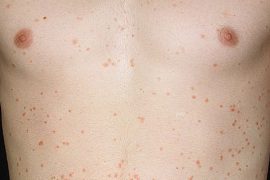 Начальные признаки псориаза – как быстро развивается болезнь