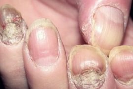 Чем лечить псориаз ногтей на руках и ногах в домашних условиях