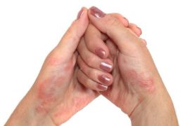 Как вылечить псориаз ногтей?
